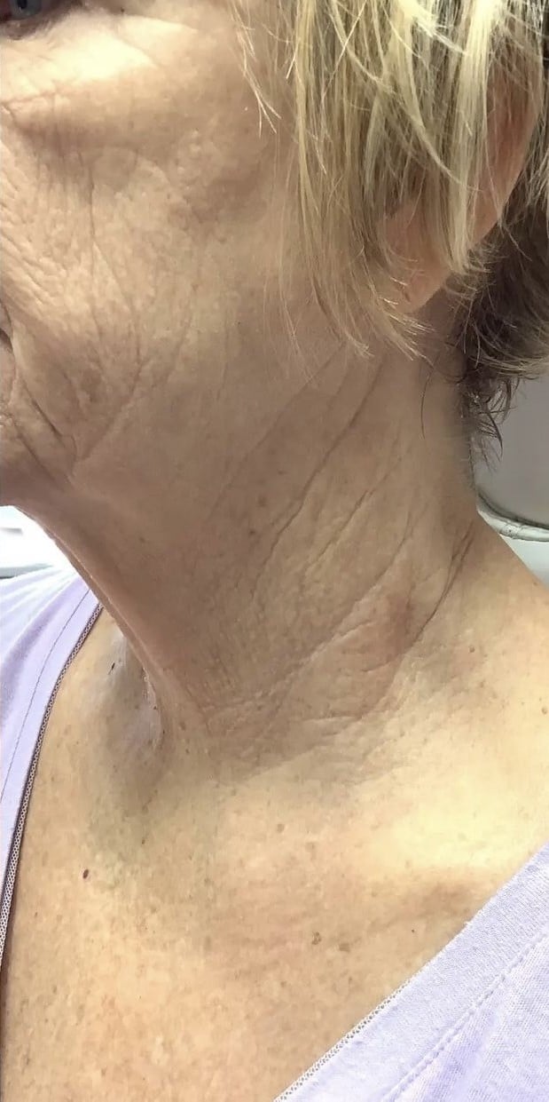 After Image: Zaffiro Skin Tightening - left-front-oblique